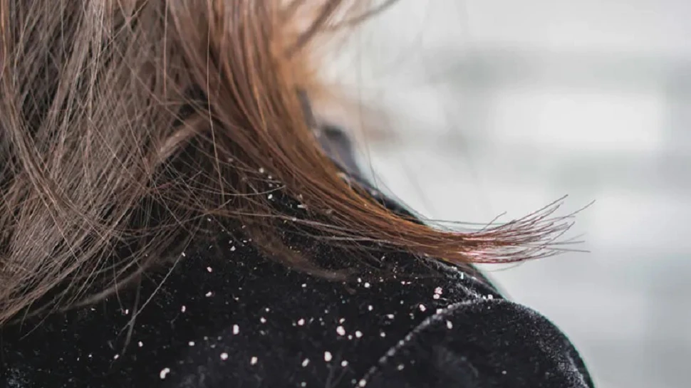 Dandruff treatment dry scalp are dangerous for hair health try these 3 neem hair mask for hair problem sscmp | Dandruff home remedies: बालों की सेहत के लिए खतरनाक है डैंड्रफ और स्कैल्प, ट्राई करें नीम के ये घरेलू हेयर मास्क