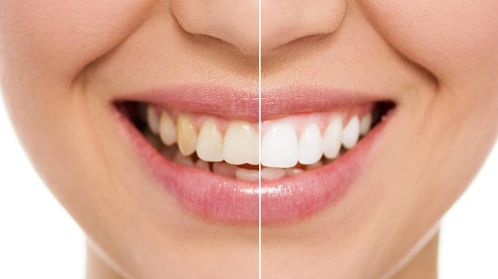 Make your yellow teeth to white with these 5 home remedies oral health teeth whitening tips sscmp | इन 5 घरेलू उपचारों से पीले दांतों को करें Good Bye, चमक उठेगी आपकी मुस्कान