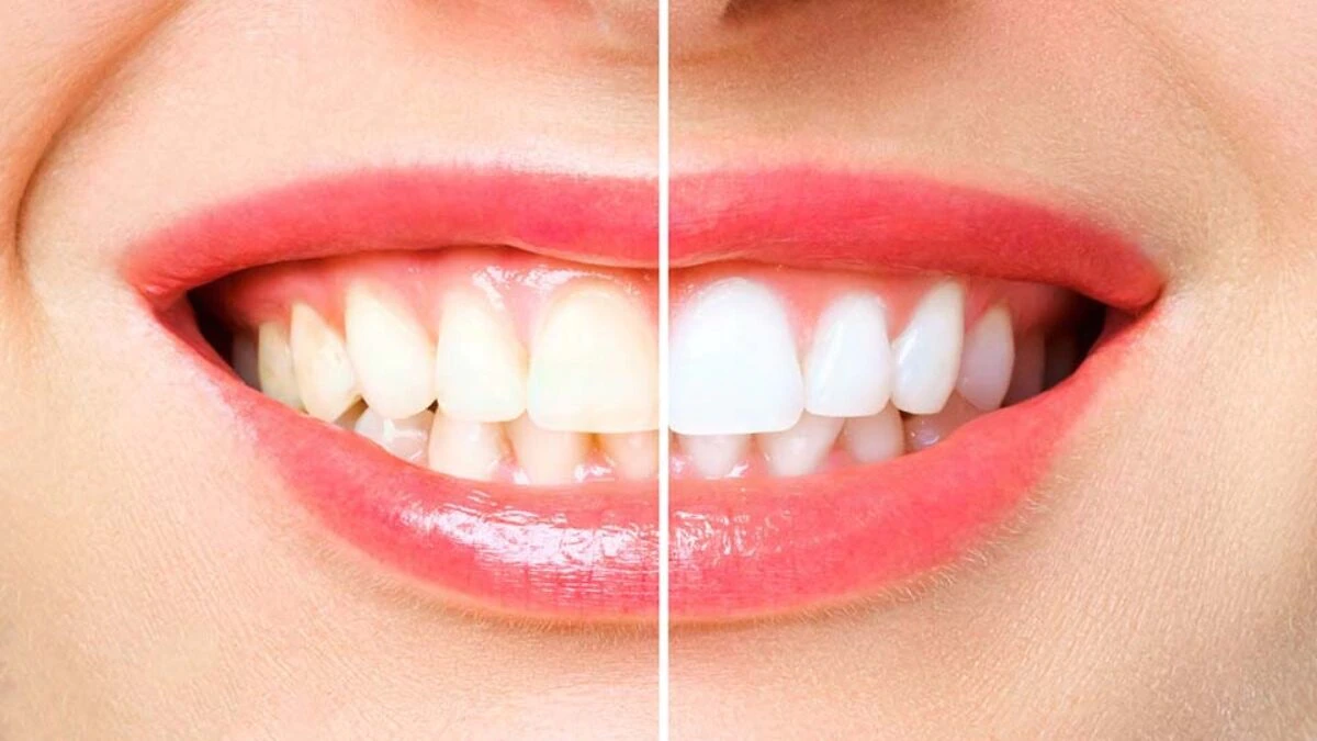 Teeth Whitening: Remove these 4 foods from your diet plan to get rid of yellow teeth sscmp | Teeth Whitening: पीले दातों से पाना चाहते हैं छुटकारा? तो तुरंत इन 4 फूड्स को अपनी डाइट से हटा दें