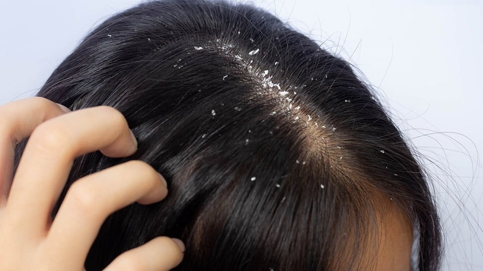 Dandruff Home Remedies Follow these Ayurvedic treatment to get rid of dandruff hair fall solution sscmp | Dandruff Home Remedies: डैंड्रफ से छुटाकारा पाने के लिए घर पर अपनाएं ये आयुर्वेदिक नुस्खे, बालों का झड़ना भी होगा कम