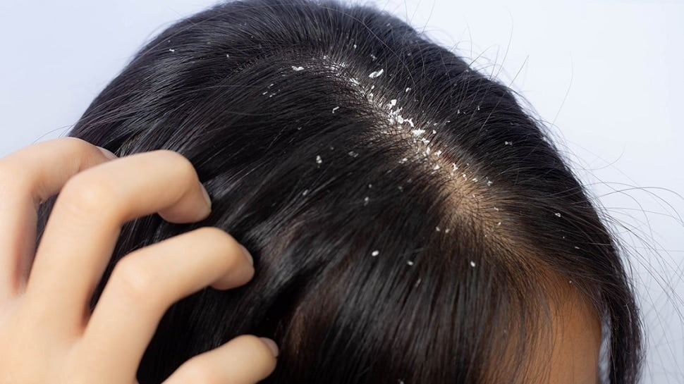 Winter hair care: know how to take good care of hair in winter 5 home remedies to get rid of dandruff sscmp | Winter hair care: सर्दियों में बालों की करें अच्छी देखभाल, डैंड्रफ से छुटकारा पाने के 5 घरेलू उपाय