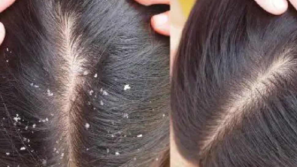 winter dry hairs and dandruff hair care try home remedies nsmp | Winter Hair Care: बालों में डैंड्रफ से हैं परेशान तो इस तरह करें देखभाल, अपनाएं ये घरेलू उपाय