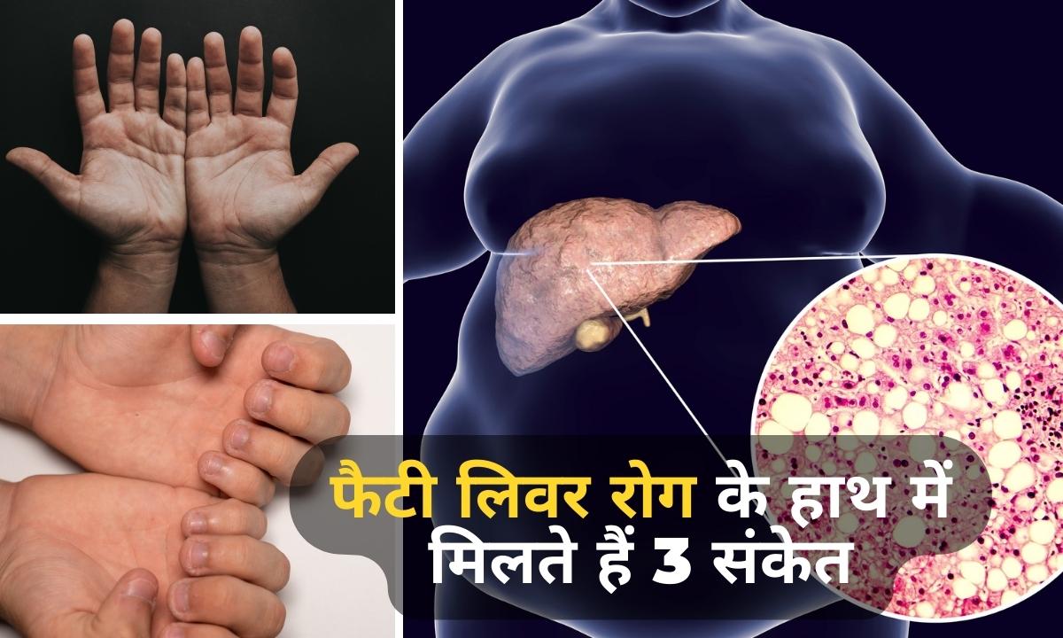 Cirrhosis symptoms: do not ignore these 3 signs on your hands that indicate advanced fatty liver disease | Cirrhosis symptoms: हाथों पर मिलते हैं फैटी लिवर डिजीज के संकेत, इन 3 Warning Signs को ना करें नजरअंदाज