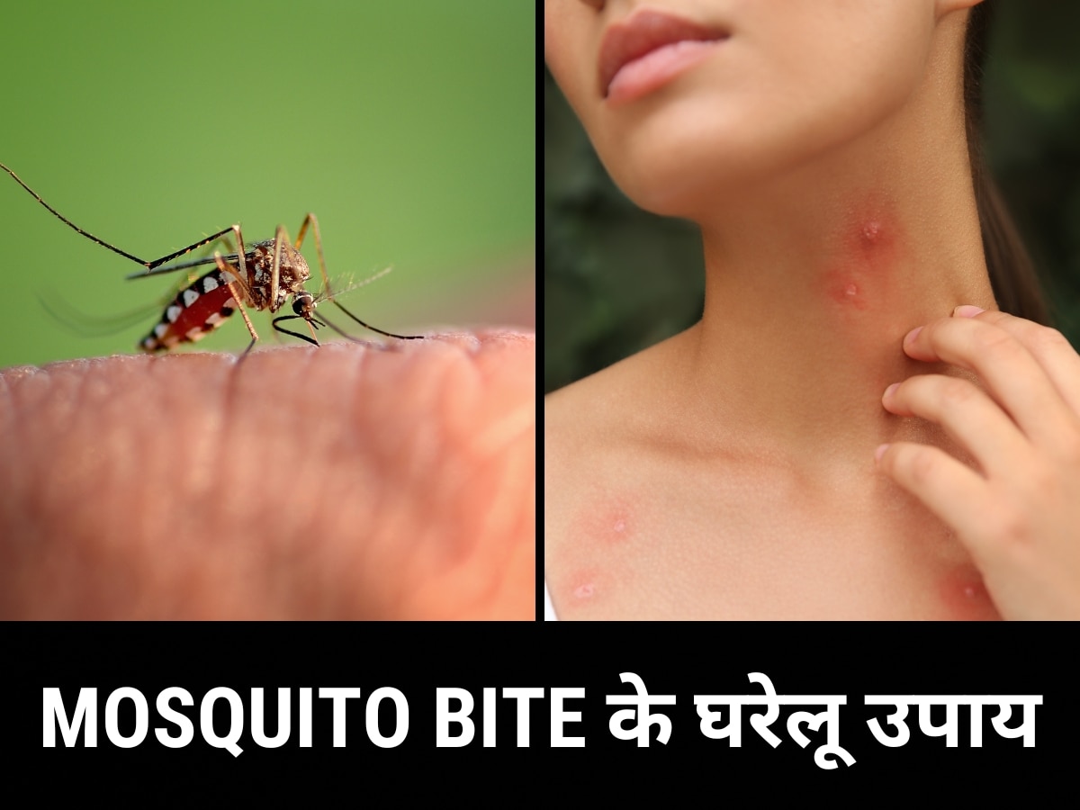 Mosquito Bite: Rashes have come out on the skin due to mosquito bites fix them with these home remedies | Mosquito Bite: मच्छर के काटने से त्वचा पर निकल आए हैं दाने? इन घरेलू उपायों से करें ठीक