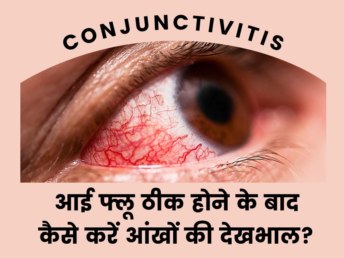 Conjunctivitis treatment tips to follow after recovery from eye flu otherwise your eyes get damage | Conjunctivitis Eye Flu: आई फ्लू ठीक होने के बाद भी आंखों को पहुंच सकता नुकसान! ये लापरवाही बरतना पड़ेगा महंगा