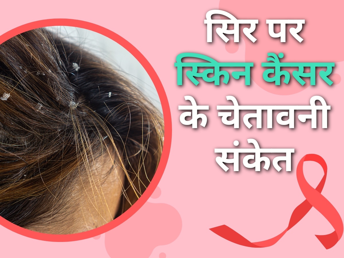 Warning signs of skin cancer are also visible in head do not be mistaken for dandruff cancer symptoms in hindi | Skin Cancer: सिर से भी मिलते हैं स्किन कैंसर के चेतावनी संकेत, डैंड्रफ समझने की न करें भूल
