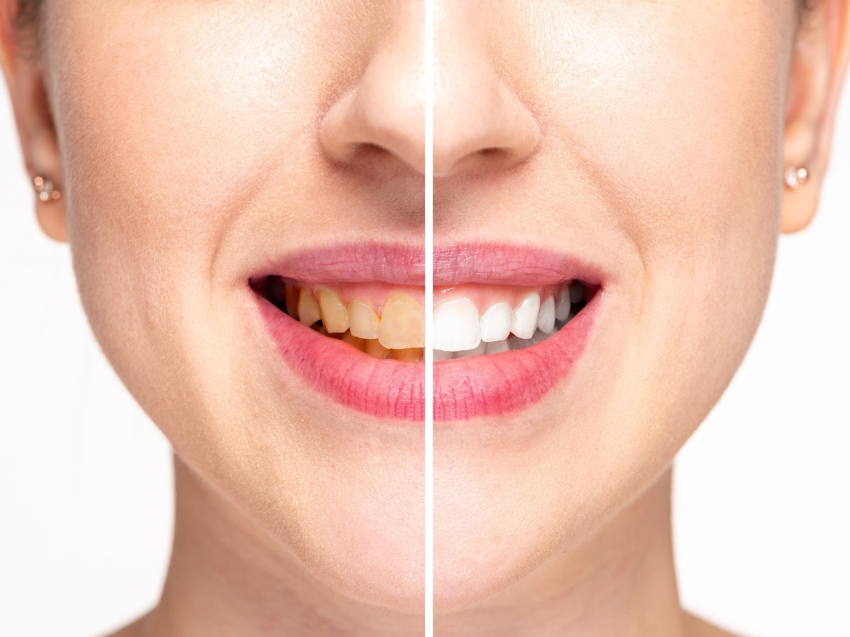 5 home remedies to clean plague from teeth and get rid of mouth smell how to get rid of yellow teeth | Natural Teeth Whitening: दांतों से पीलापन हटाएंगे ये 5 घरेलू उपाय, मोती की तरह चमकने लगेंगे आपके दांत