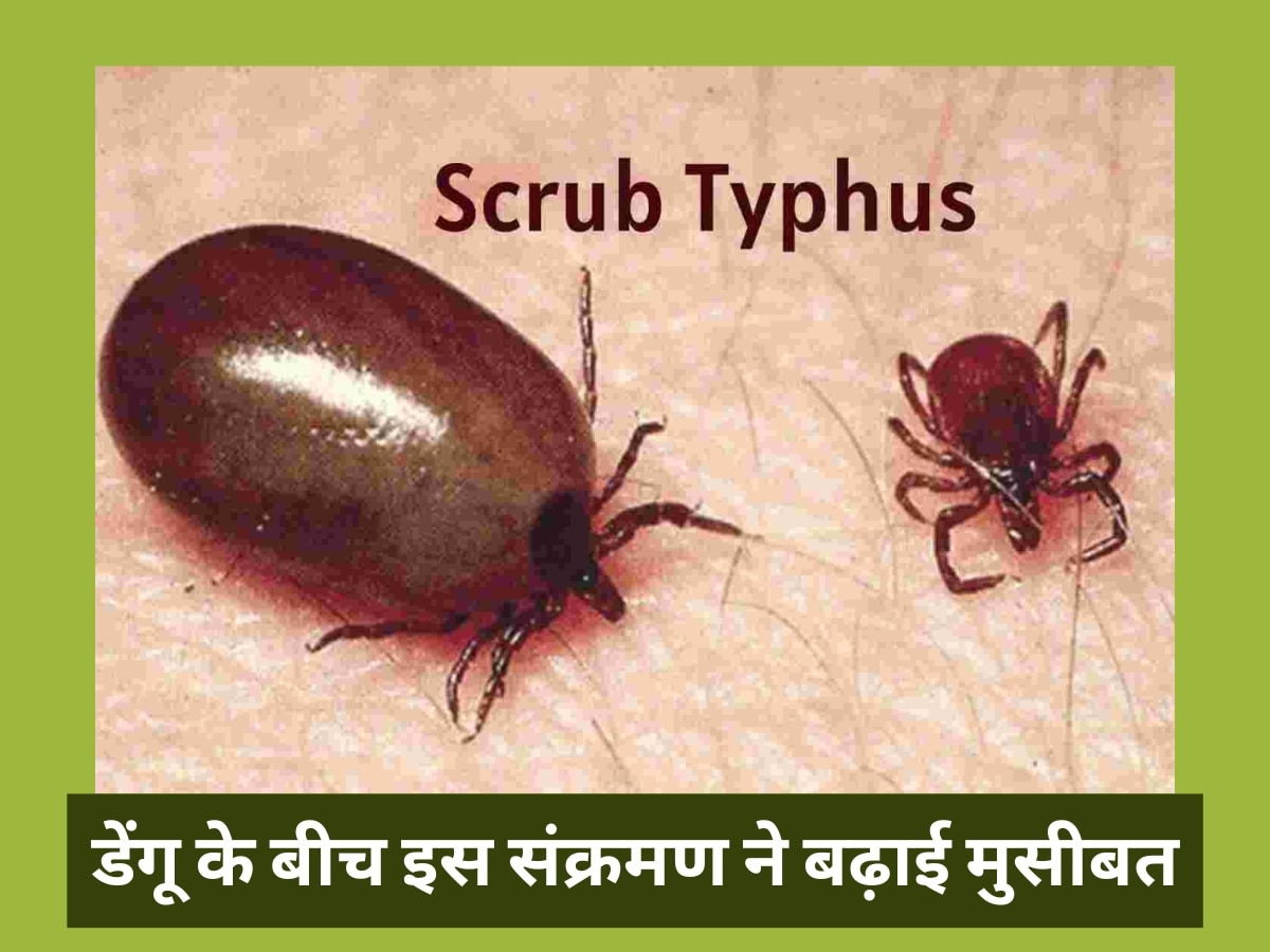 Deadly infection scrub typhus increased trouble people amidst dengue know scrub typhus symptoms in hindi | Scrub Typhus: डेंगू के बीच इस जानलेवा संक्रमण ने बढ़ाई लोगों की मुसीबत, डॉक्टरों ने जारी की चेतावनी