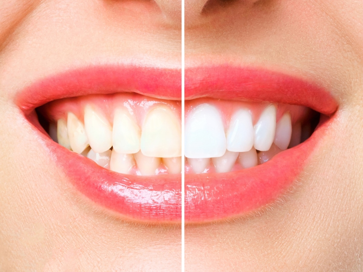Teeth whitening home remedies chew sesame seeds to convert yellowish teeth to white | दिन में दो बार ब्रश करने के बाद भी नहीं जा रहा दांतों से पीलापन? अपनाएं ये देसी नुस्खा, मोतियों की तरह चमक उठेंगे दांत
