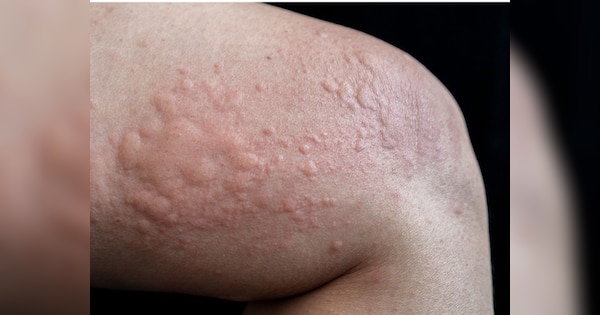 Get allergy test done to avoid itching rashes and respiratory problems | Allergy: खुजली, चकत्ते और सांस की समस्याओं से बचने के लिए करवाएं एलर्जी टेस्ट