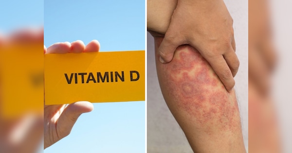 Vitamin d deficiency can cause weak bones and eczema in children prevention tips to follow | विटामिन डी की कमी से हड्डियों में कमजोरी समेत बच्चों में बढ़ जाता है इस गंभीर बीमारी का खतरा, जानें बचाव के उपाय